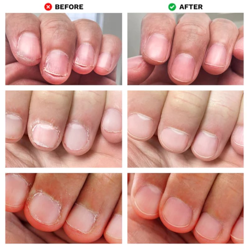 Londontown No Bite Nail Recovery Genomskinlig 3